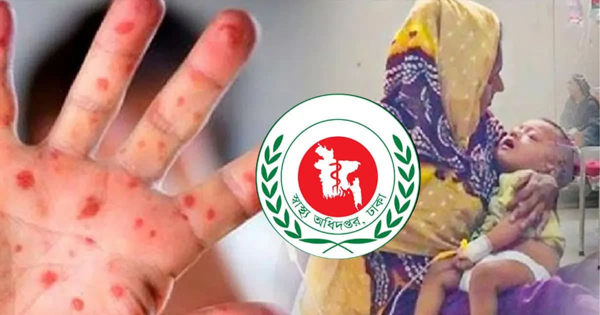 হাম উপসর্গে ৫ শিশুর মৃত্যু